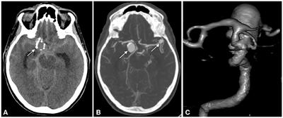 Endovascular treatment of an aneurysm associated with fenestration of the supraclinoid internal carotid artery: Case report and review of the literature